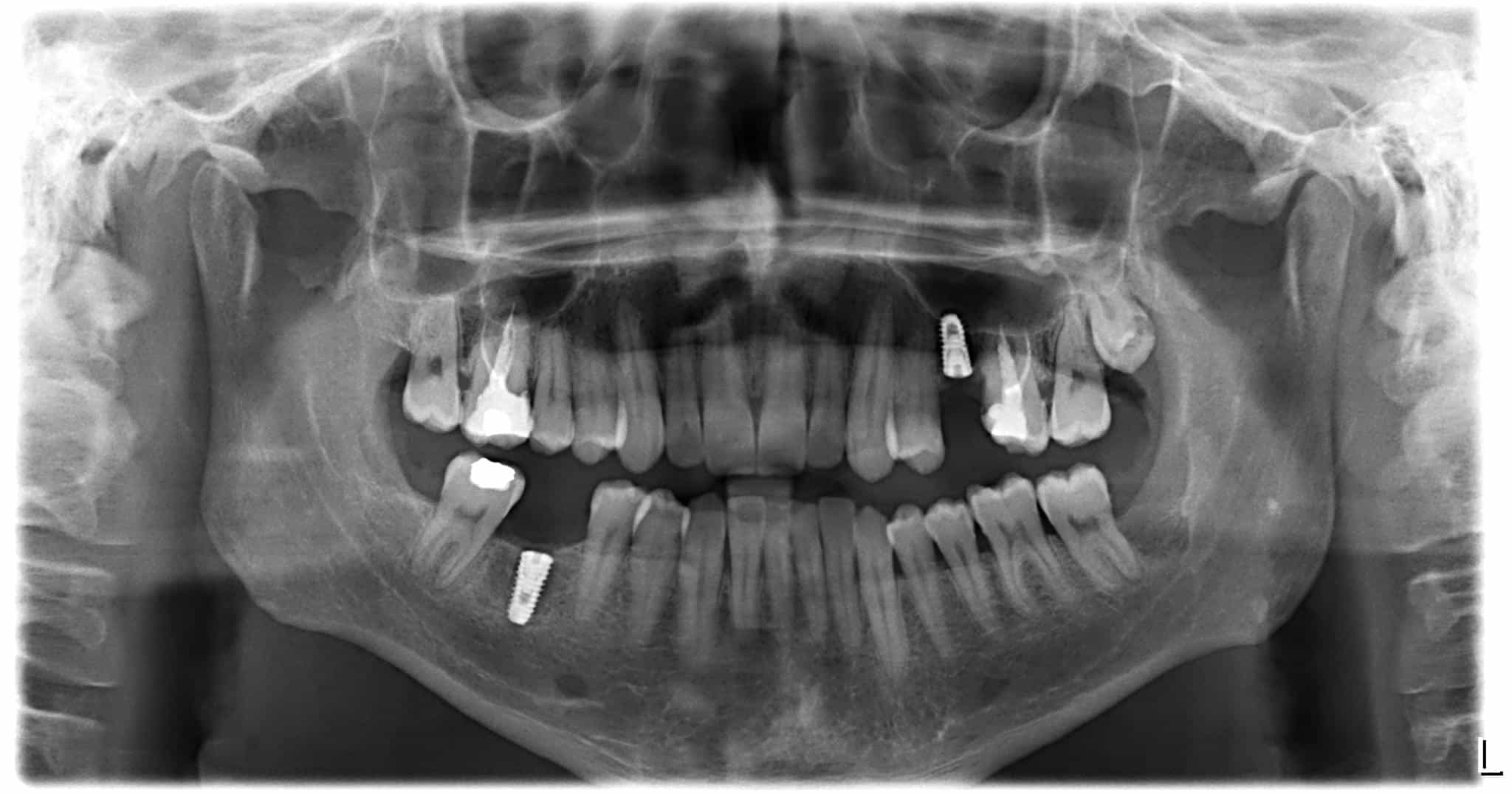 dental implant operation in antalya