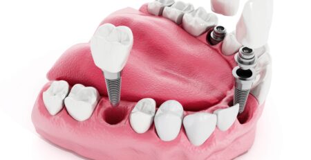 Dental Implant Tooth Turkey
