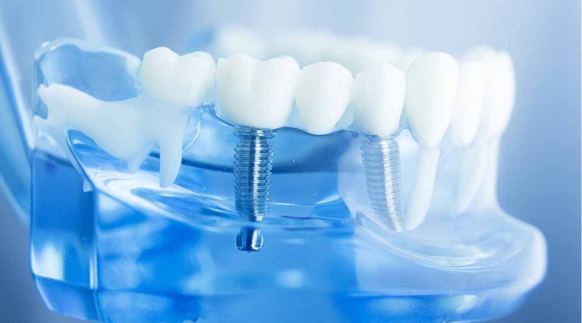 who is suitable for dental implants