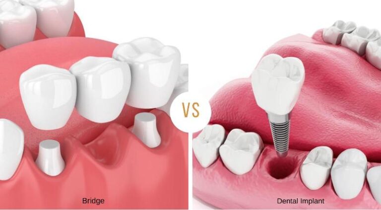 Welches ist besser? Zahnimplantat oder Brücke - Adalya Dental Clinic