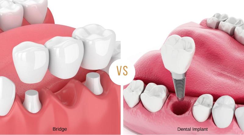 Which is better? dental implant or bridge