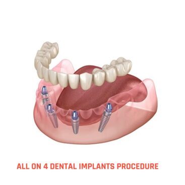 all on 4/four dental implants procedure turkey price