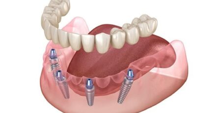 all on 4/four dental implants procedure turkey price