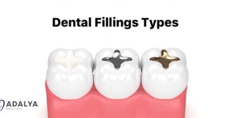 Dental fillings types
