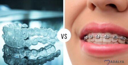 Invisalign vs. Zahnspange, was besser ist
