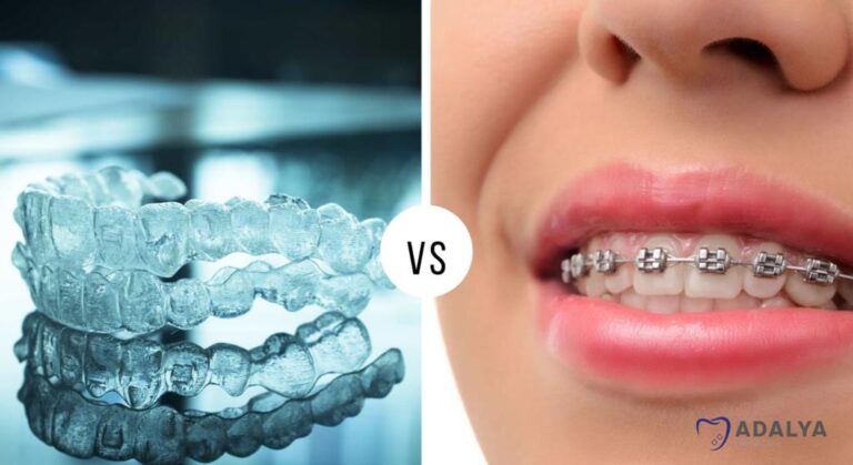 Invisalign Vs Braces Which Is Better For You Antalya Dental Clinic