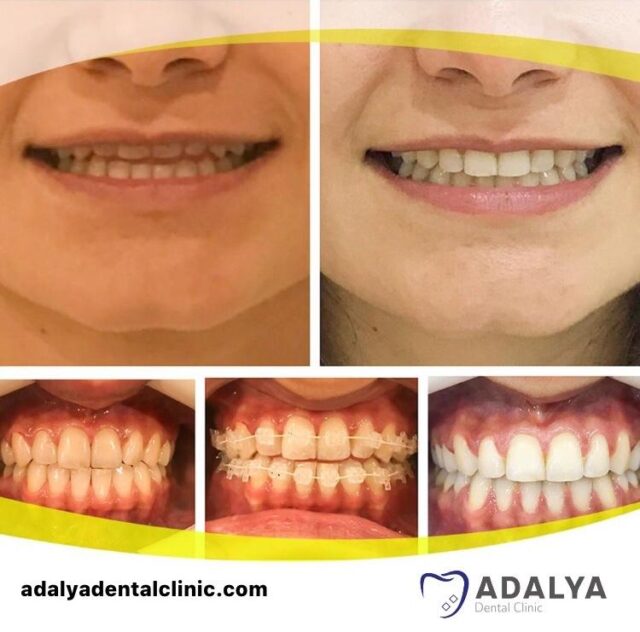 Braces in Turkey Dental Braces Cost, Types, Treatment Abroad