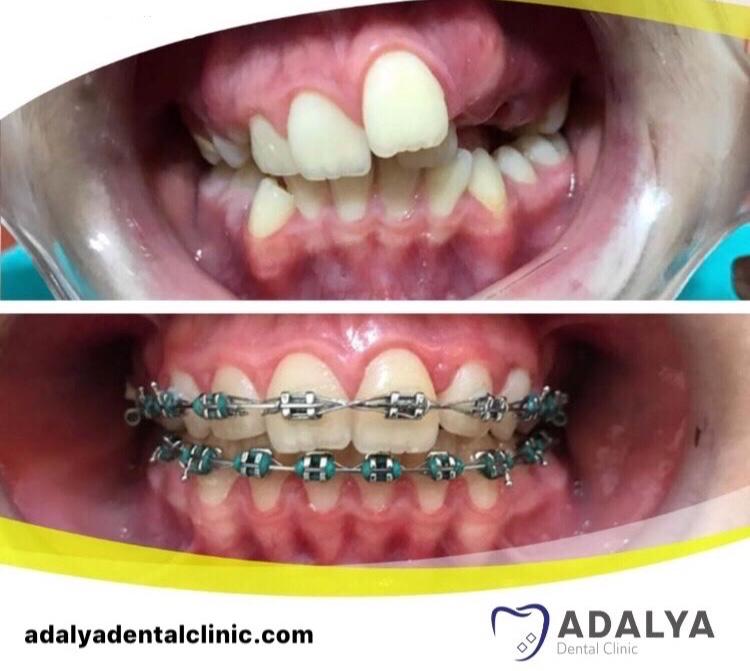 Traditional Braces Cost in Gurgaon