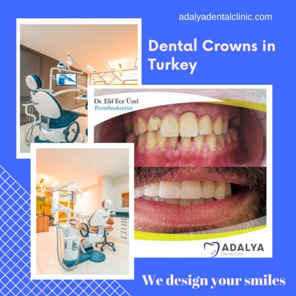 Dental Crowns Turkey Full Mouth Dental Crowns Cost in Turkey Antalya