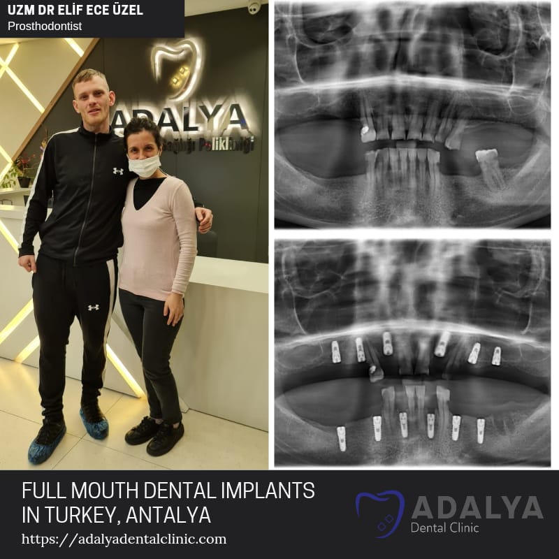 tooth implants turkey antalya