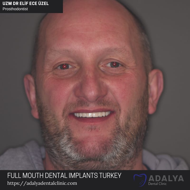 Türkei Zahnimplantate