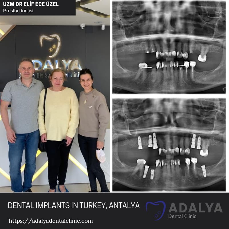 turkey teeth implants antalya