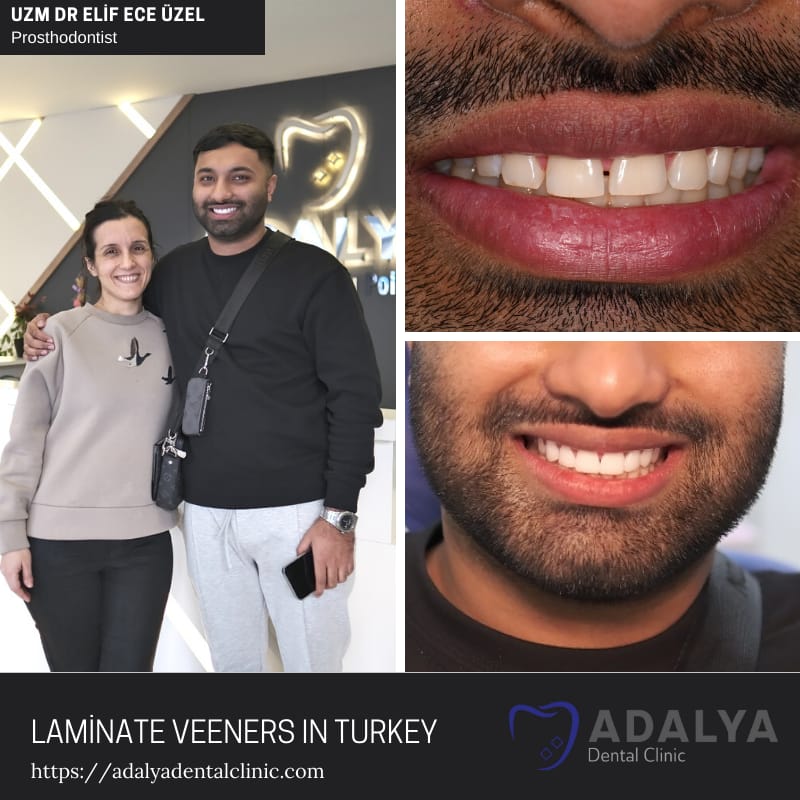turkey teeth veneers antalya