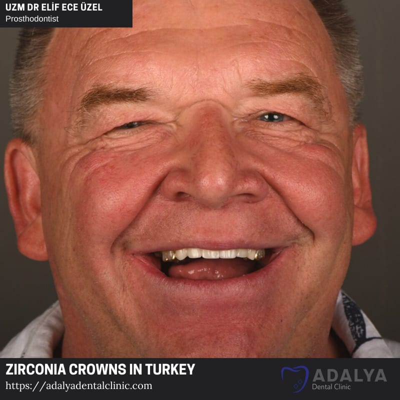 zirconia porcelain dental veneers turkey antalya price
