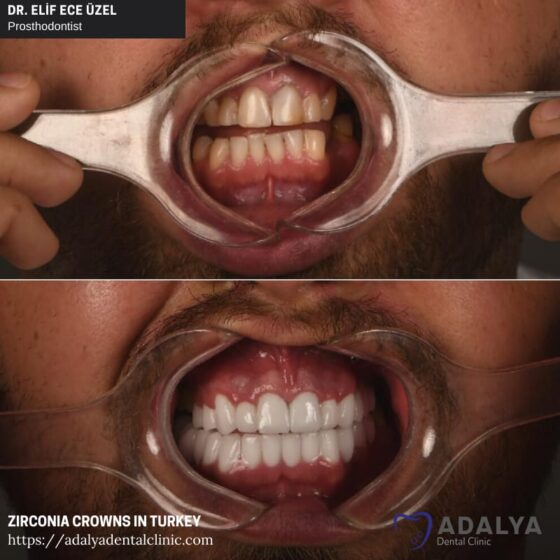 Dentistry Turkey Cosmetic Dentistry Antalya Adalya Dental Clinic
