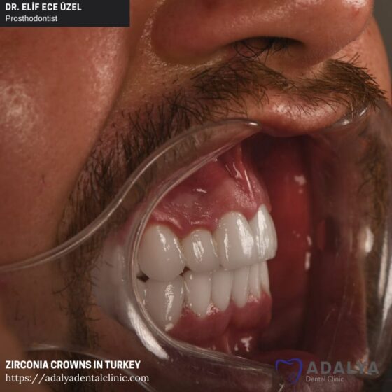 Dentistry Turkey Cosmetic Dentistry Antalya Adalya Dental Clinic