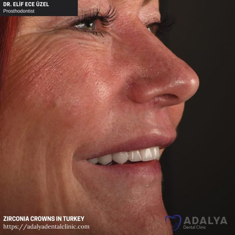 Zirconia Crown Turkey How Is It Prepared? Price? Adalya Dental Clinic