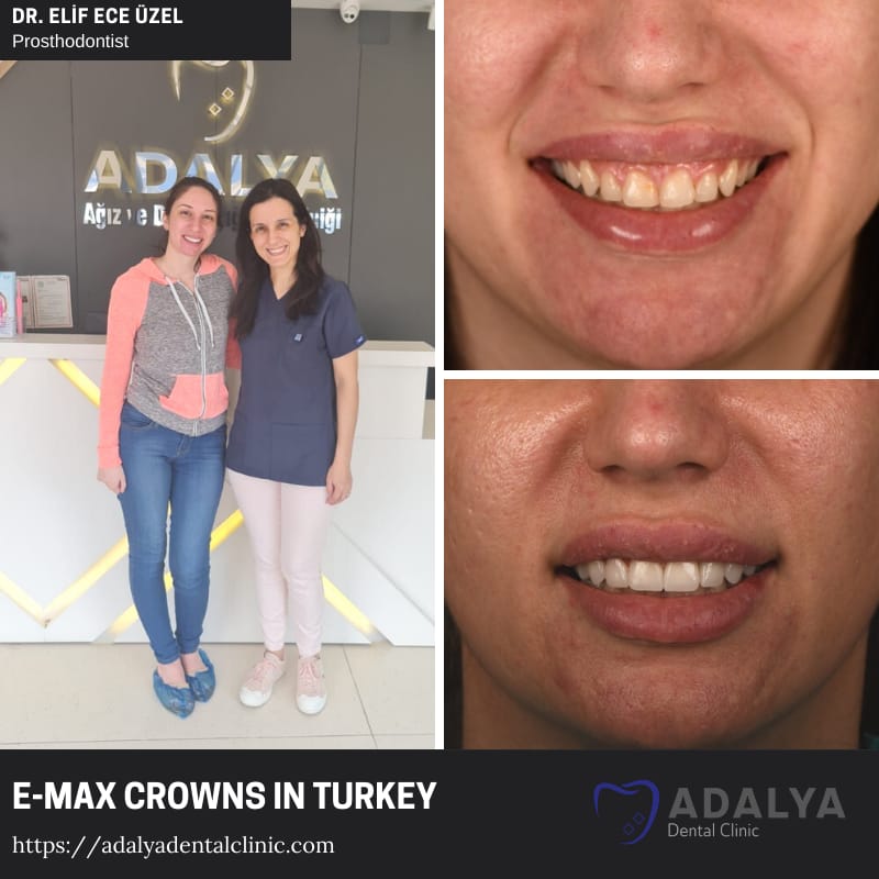 dental emax porcelain crowns turkey antalya
