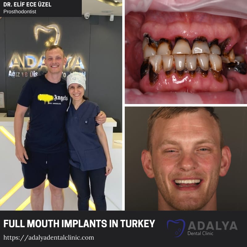 Klinik für Zahnimplantate Antalya Türkei