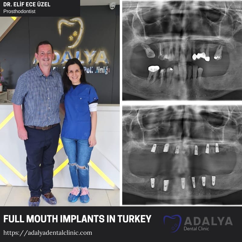 dental implants dentistry turkey antalya prices