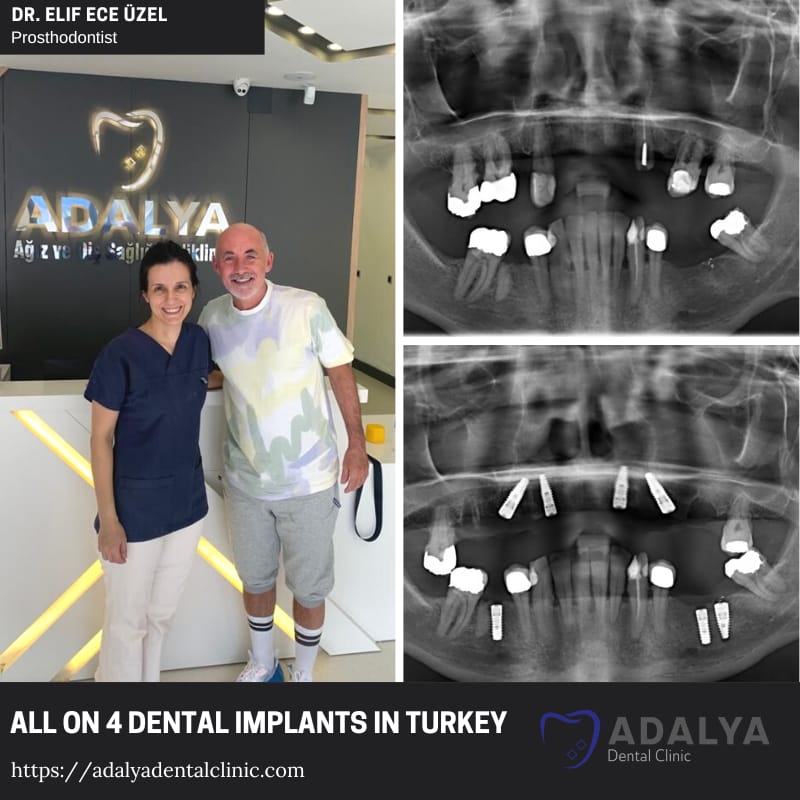 Zahnarzt in der Türkei Antalya Kosten für Zahnimplantate