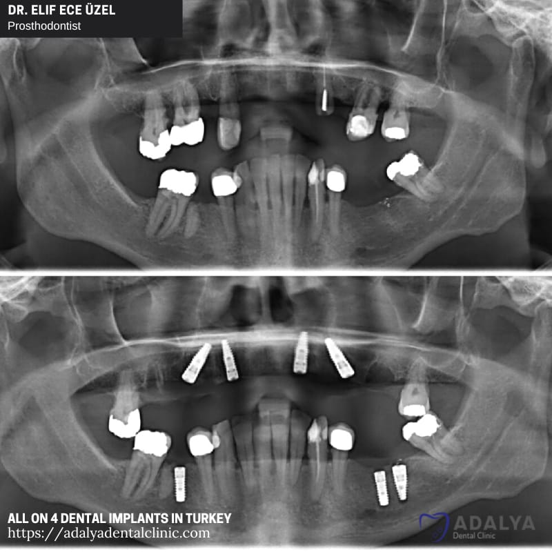 dentist in turkey antalya dental implants price