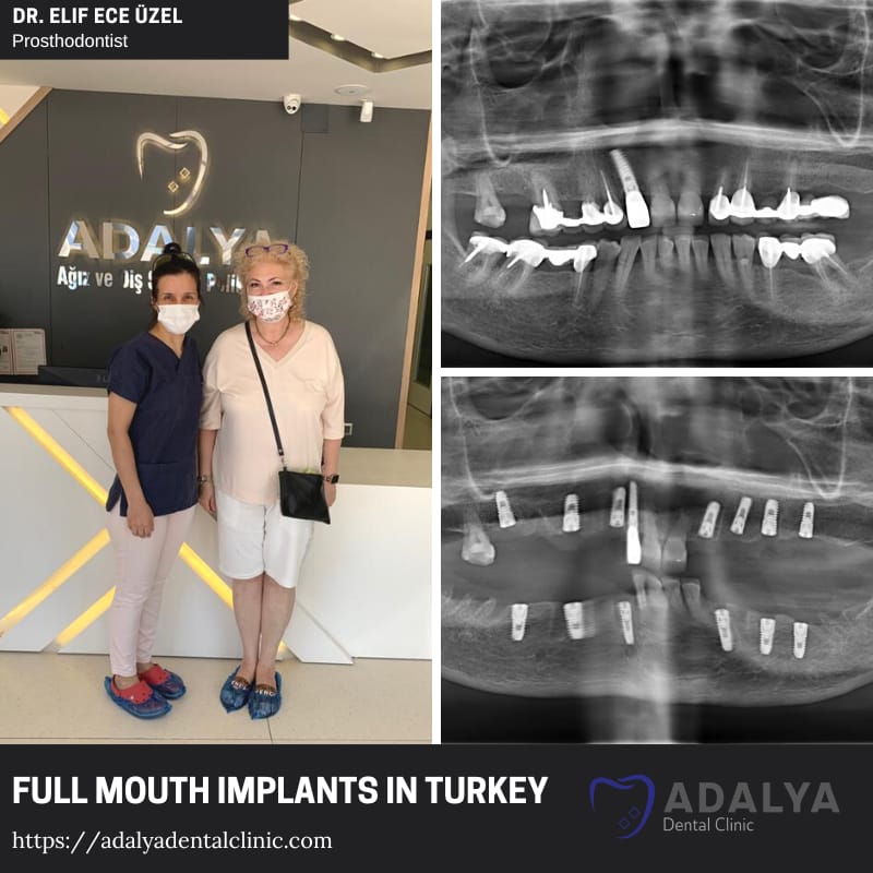 dentist turkey antalya dental implants cost