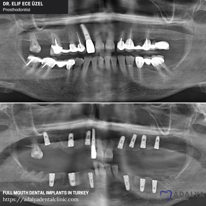 dentist turkey antalya dental implants price