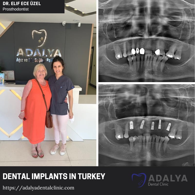 dentist turkey antalya istanbul dental implants cost