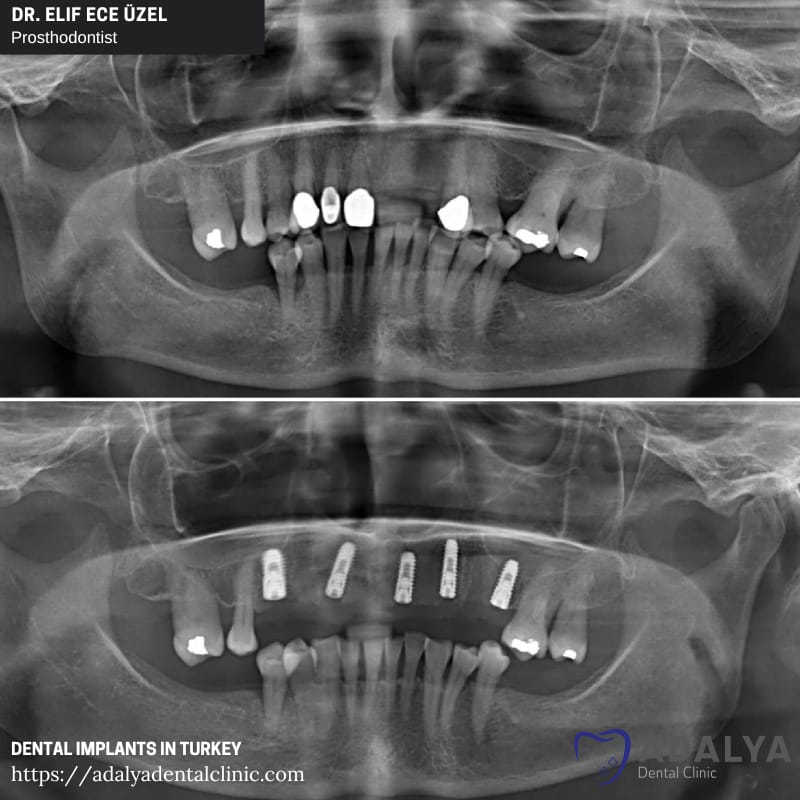 dentist turkey antalya istanbul dental implants prices
