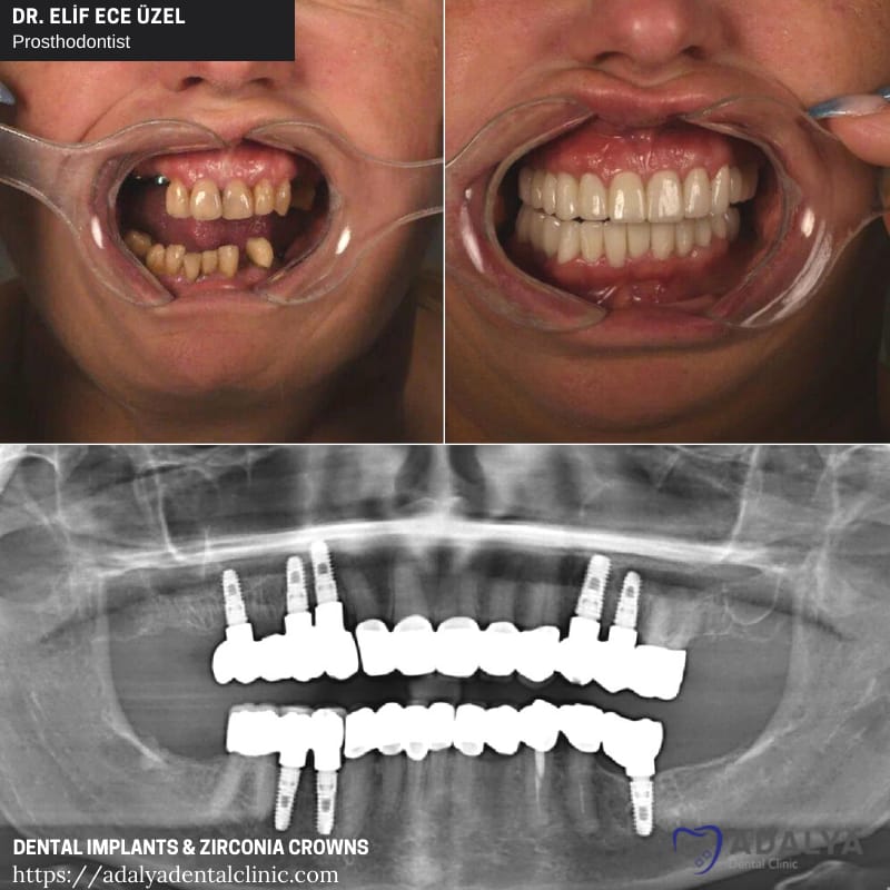 tooth implants antalya turkey zirconium crowns cost