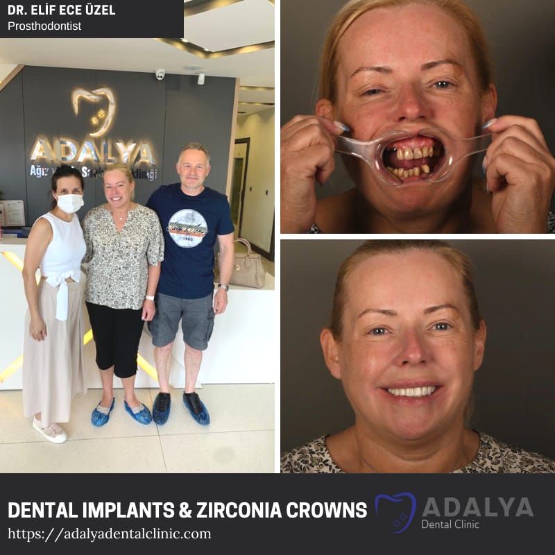 tooth implants turkey antalya zirconium dental crowns prices cost istanbul marmaris