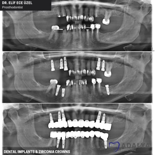 Dentistry Turkey Cosmetic Dentistry Antalya Adalya Dental Clinic