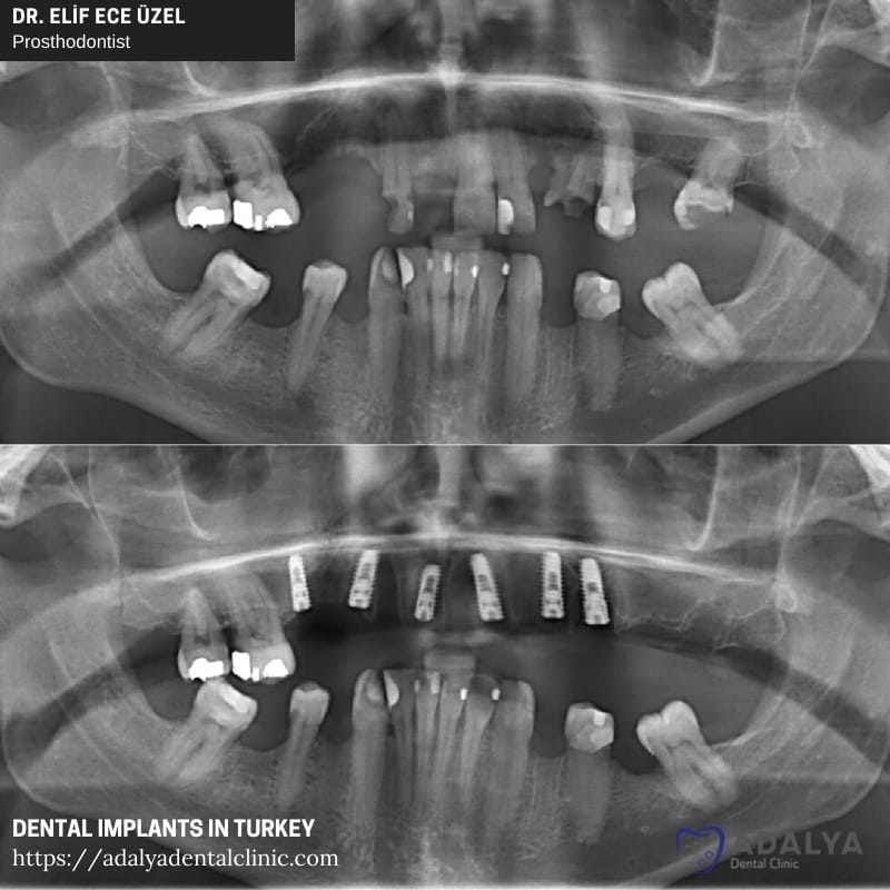 turkey dentist antalya ankara dental implants price