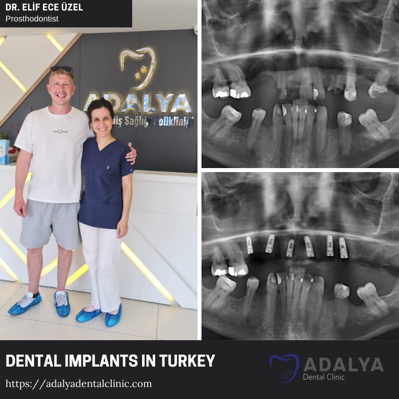 turkey-dentist antalya istanbul dental implants cost