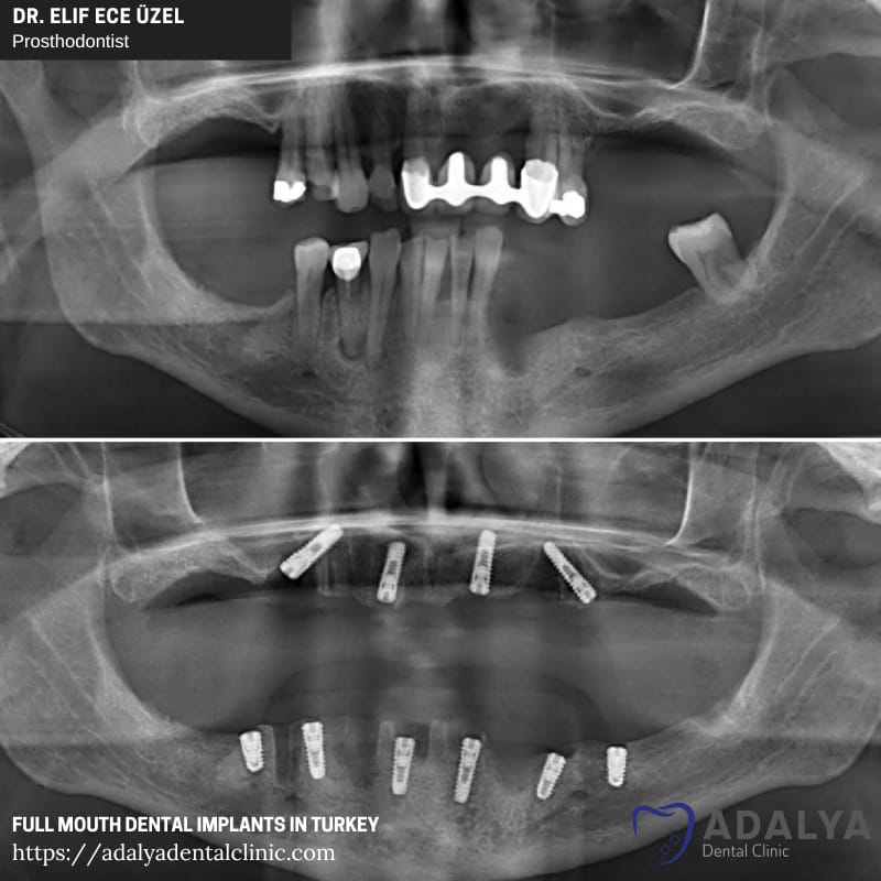 turkey dentist antalya istanbul tooth implants price