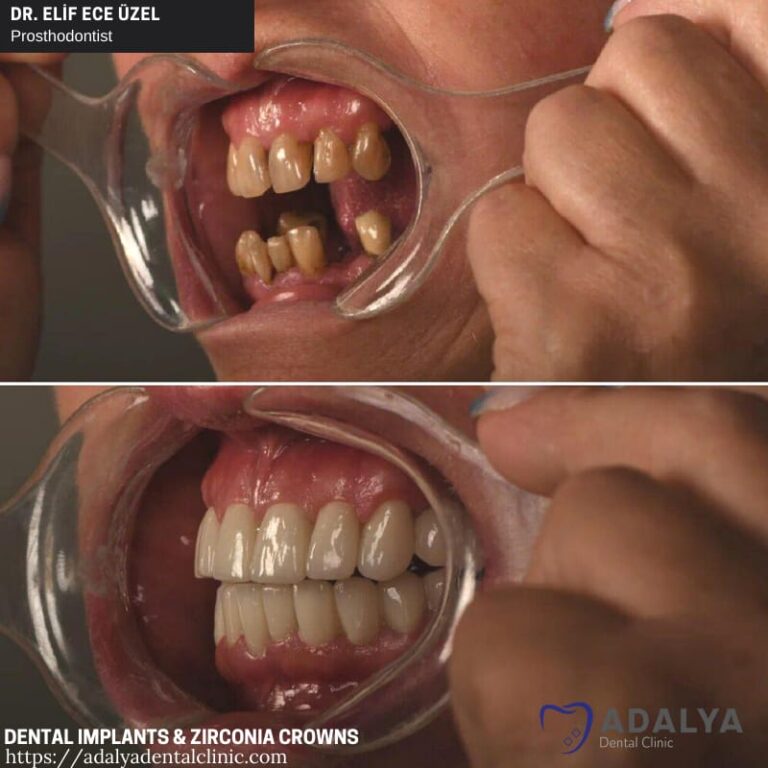 Dentistry Turkey Cosmetic Dentistry Antalya Adalya Dental Clinic