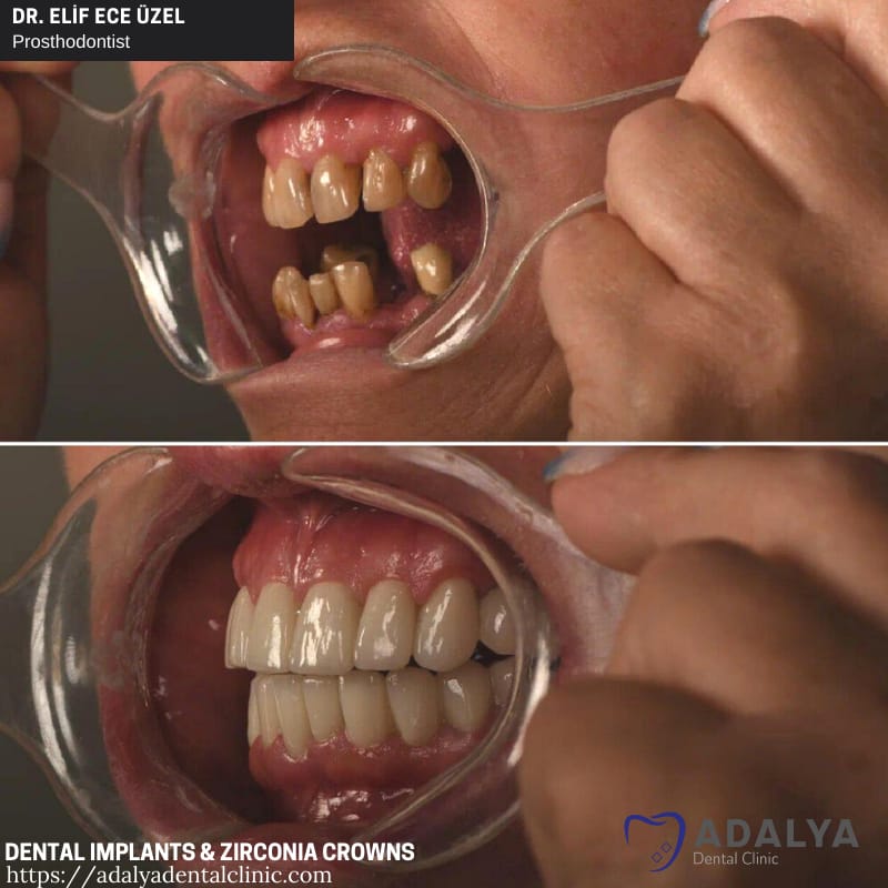 turkey teeth implants zirconia crowns antalya