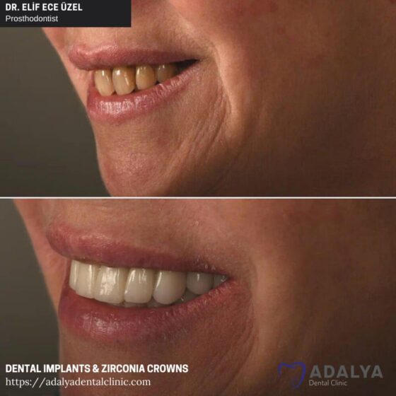 Dentistry Turkey Cosmetic Dentistry Antalya Adalya Dental Clinic