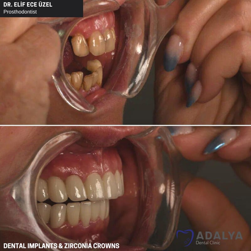 turkey teeth implants zirconia crowns antalya price