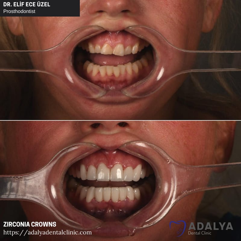 turkey dental teeth zirconia crowns veneers cost