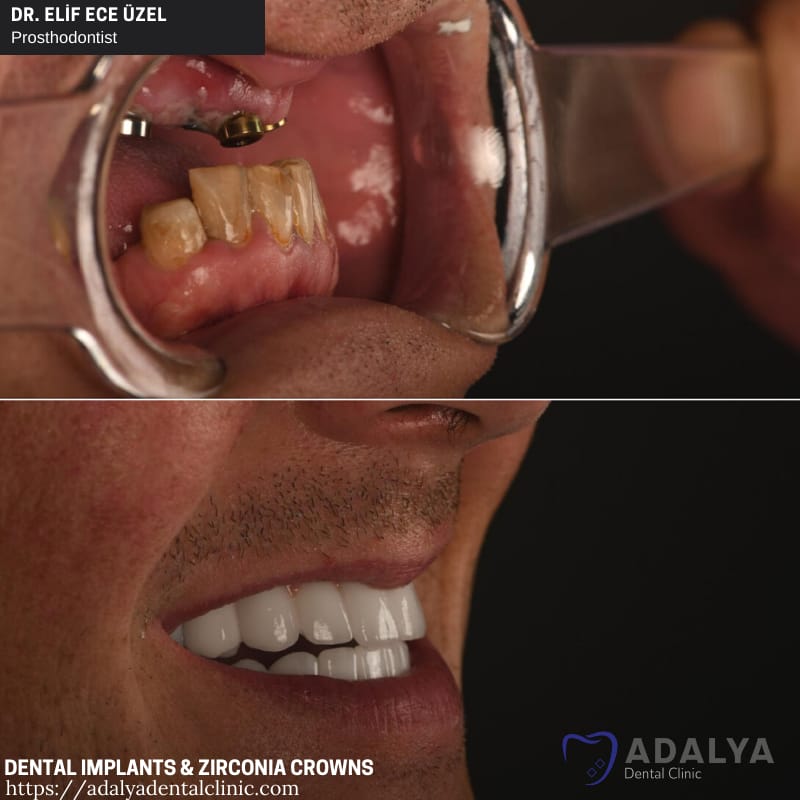 dentist turkey teeth implants antalya cost prices marmaris istanbul