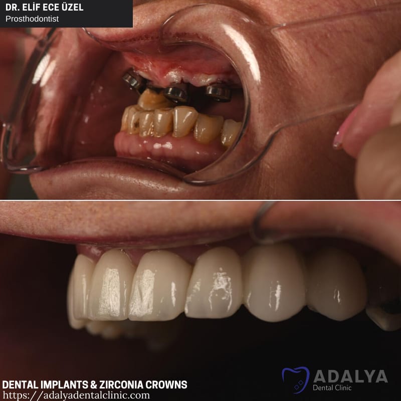 tooth dental implants turkey antalya alanya istanbul cost