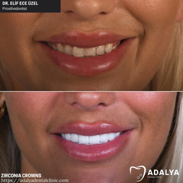 Dentistry Turkey Cosmetic Dentistry Antalya Adalya Dental Clinic