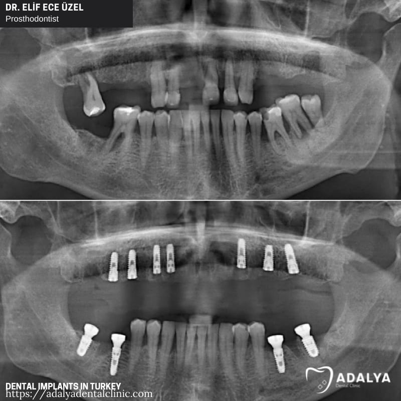 dental implant clinic turkey antalya istanbul cost prices