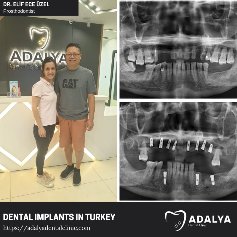 dental implant clinic turkey antalya istanbul trakya cost