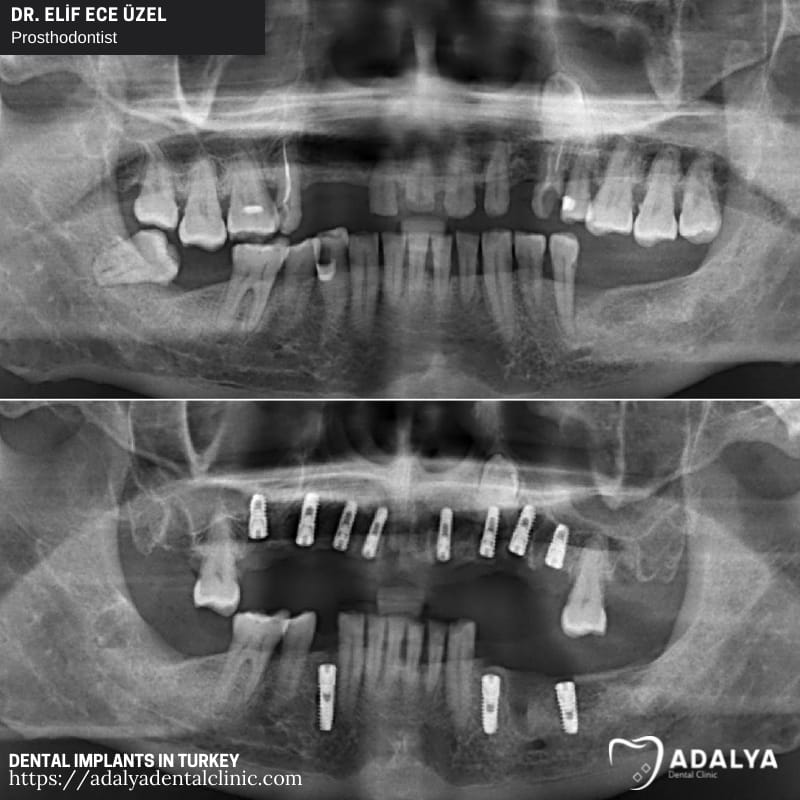 dental implant clinic turkey antalya istanbul trakya prices