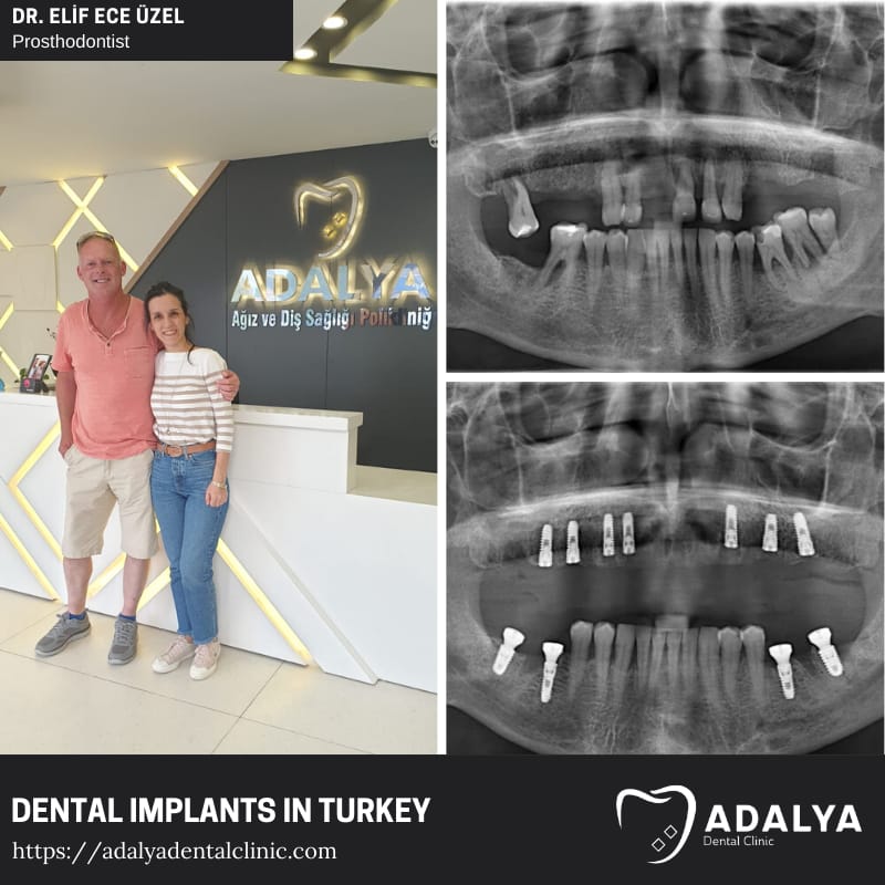 klinik für zahnimplantate türkei antalya istanbul