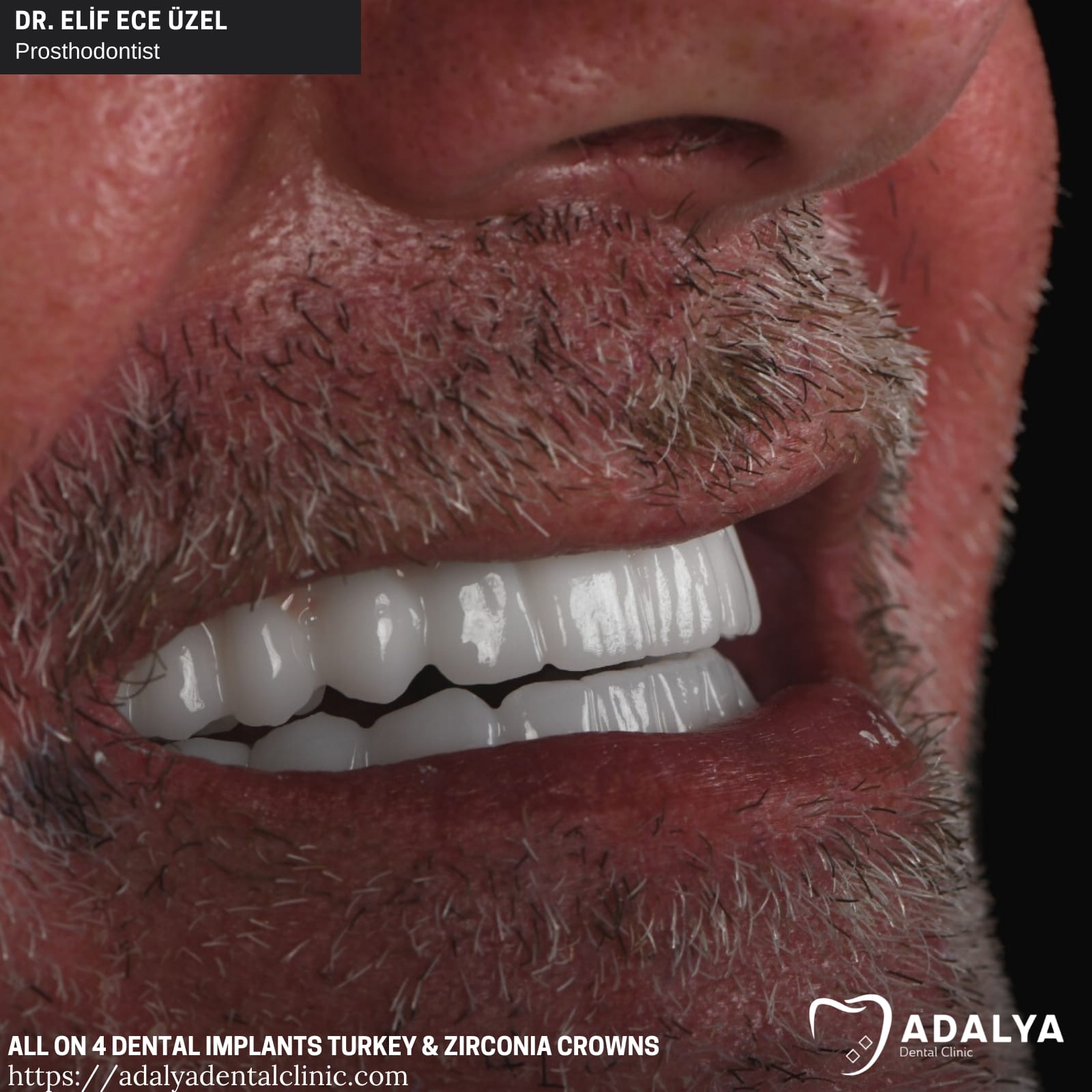 adalya all on 4 dental implants turkey price antalya cost