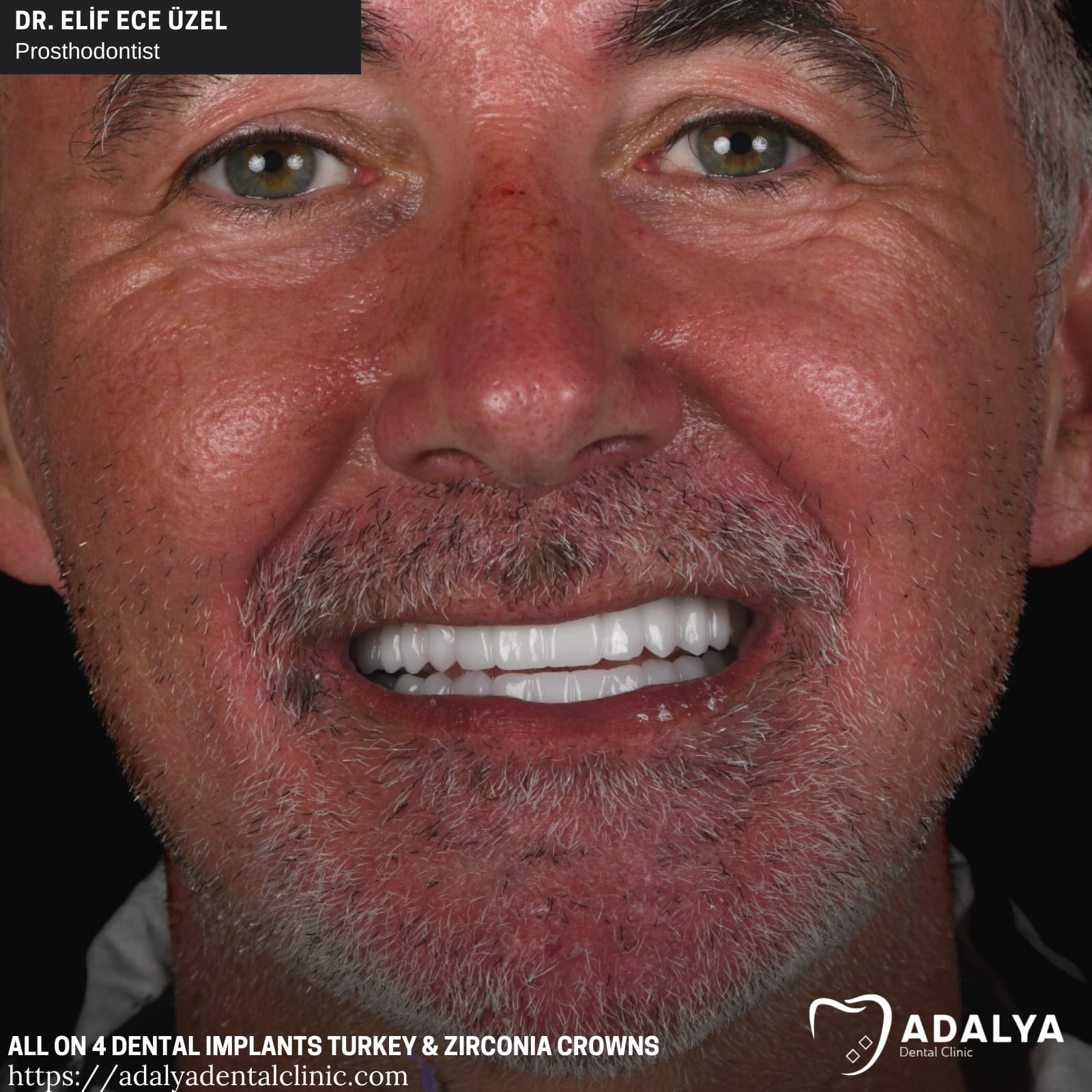 adalya all on 4 dental implants turkey price antalya